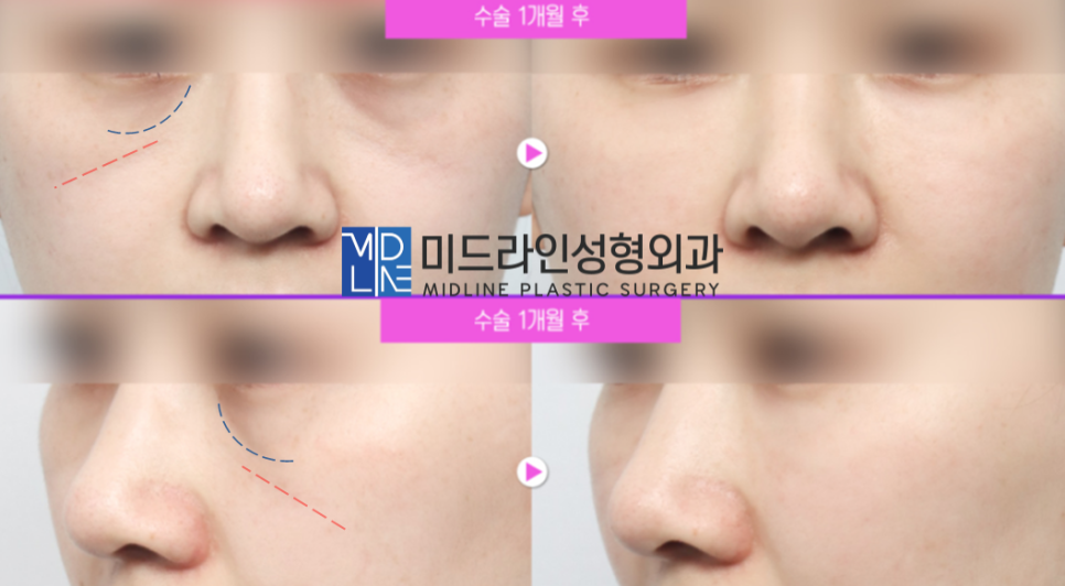 인디언 주름 고민 해결! 중안면부 리프팅에 대하여 설명드립니다. 관련 이미지 13