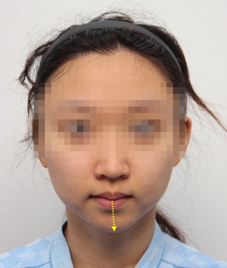 무턱 교정하면서 턱끝 비대칭(안면비대칭)까지 바로잡기! 관련 이미지 12
