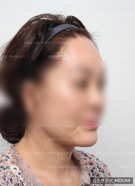 얼굴 주름 리프팅, 오래 지속되고 효과 좋은 수술방법은? 관련 이미지 12