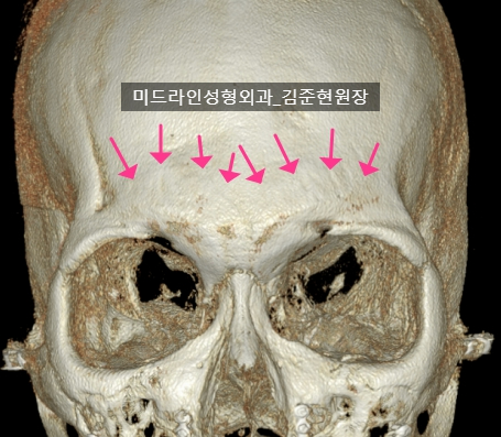 눈썹뼈 절삭에 관하여 (안와상융기) 관련 이미지 15