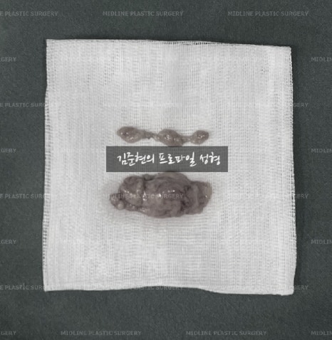 이중턱 근육 묶길 잘했어요^-^ 이중턱 근육묶기와 근육 밑 지방(포도송이 지방)제거까지 성형외과 전문의가 설명드립니다. 관련 이미지 6