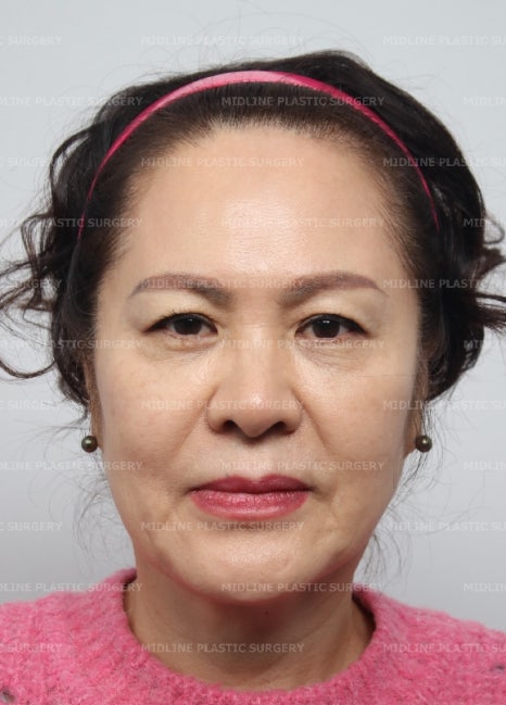 얼굴 주름 리프팅, 오래 지속되고 효과 좋은 수술방법은? 관련 이미지 8