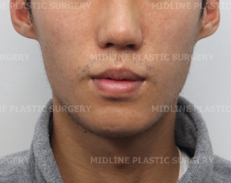 A Plastic Surgeon Explains the Changes in the Front and Side Views After Reduction Genioplasty and Advancement Genioplasty. (Feat. Rhinoplasty) image 10