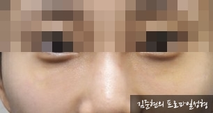 성형외과 전문의가 눈밑수술 케이스의 진단방법 및 나이들면 하는 수술이다라는 오해에 대해 설명해드립니다. 관련 이미지 4