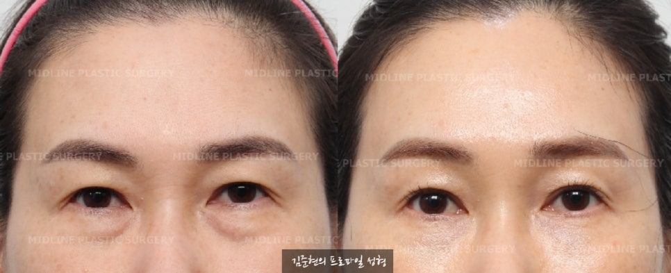 눈밑지방재배치 수술 전 눈밑 필러를 녹여야 하는 이유에 관하여 성형외과 전문의가 설명드립니다. (Feat. 이마거상) 관련 이미지 3