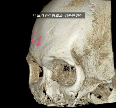 눈썹뼈 절삭에 관하여 (안와상융기) 관련 이미지 21
