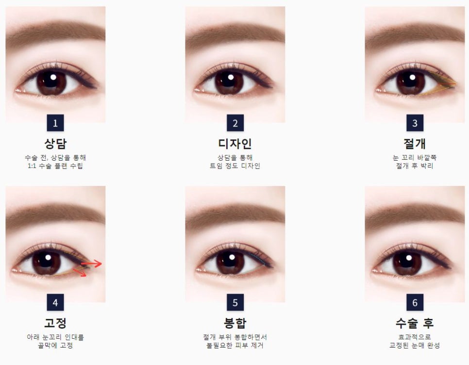 What Type of Plastic Surgery Is Needed for Small, Cramped Eyes? (About Lateral, Lower, and Combined Lateral-Lower Canthoplasty) image 8