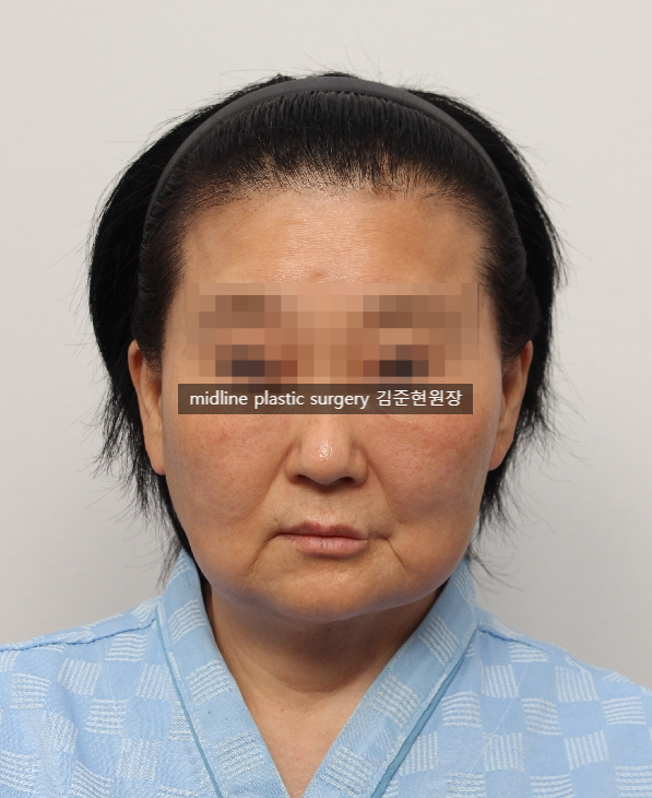 안면거상 흉터를 보여주는 곳은 없어서 미드라인성형외과가 보여드립니다. (feat. 심부볼리프팅) 관련 이미지 3
