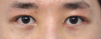 What Type of Plastic Surgery Is Needed for Small, Cramped Eyes? (About Lateral, Lower, and Combined Lateral-Lower Canthoplasty) image 13