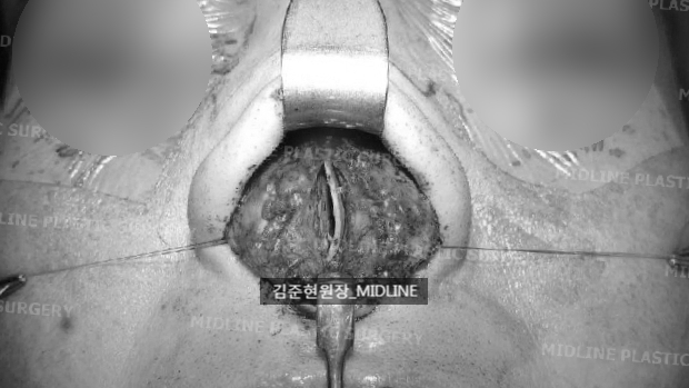 휜 코, 매부리 교정과 기능코-비중격만곡증까지 바로잡기 관련 이미지 17