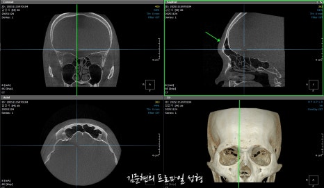 눈썹뼈절삭, 어떨 때 어떻게 하는 수술일까요? 꼭 이마거상과 함께 해야만 하는 수술인가요? 미드라인성형외과에서 하는 눈썹뼈절삭 수술을 설명드립니다. (3D CT 있음) 관련 이미지 25