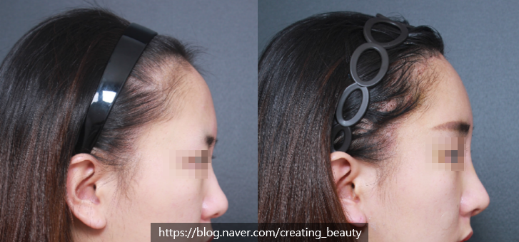 이마축소(forehead reduction)에 관하여 성형외과 전문의가 알려드립니다. 관련 이미지 7