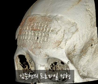 I Removed Two Forehead Implants. A Board-Certified Plastic Surgeon Explains Why I Do Not Recommend Forehead Implants. image 10