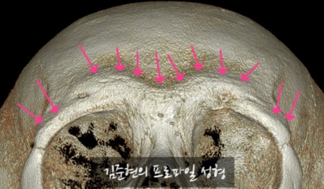 Let’s Learn About the Effects of Brow Bone Reduction Surgery. (Brow Bone? Eye Hole Bone? Here’s a Terminology Guide.) image 17