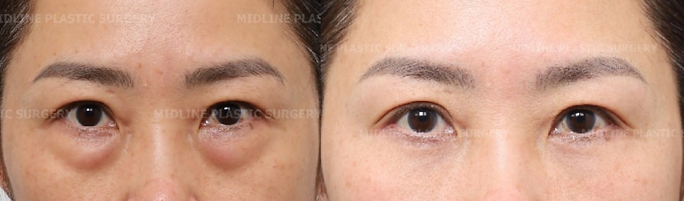 I don’t like bulging under-eye fat, dark circles, or wrinkles under the eyes. I’ll explain the no-touch lower blepharoplasty and fat grafting procedure. image 5