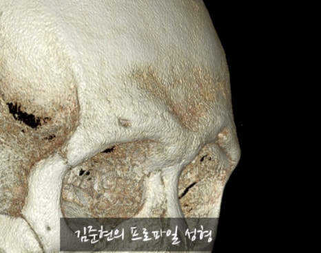 Let’s Learn About the Effects of Brow Bone Reduction Surgery. (Brow Bone? Eye Hole Bone? Here’s a Terminology Guide.) image 11