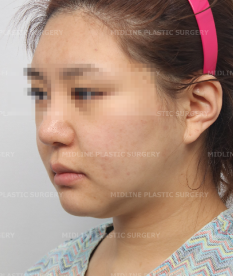 Fixing Sagging After Facial Contouring Surgery with a Face Lift!! (Feat. Plate Removal, Plate & Screw Removal) image 3
