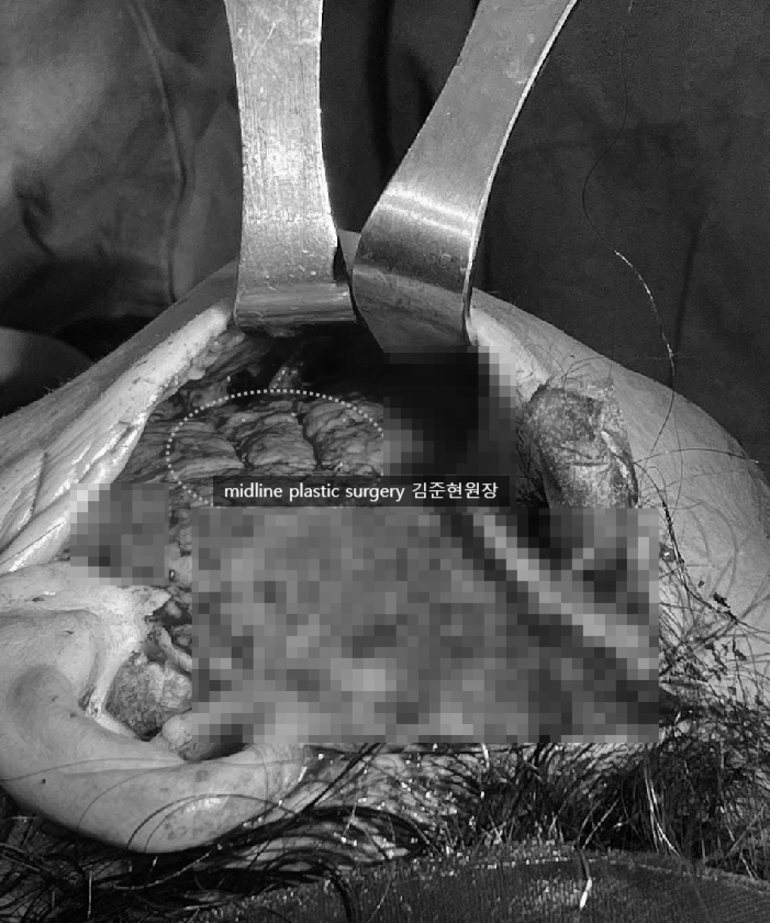 안면거상 흉터를 보여주는 곳은 없어서 미드라인성형외과가 보여드립니다. (feat. 심부볼리프팅) 관련 이미지 6