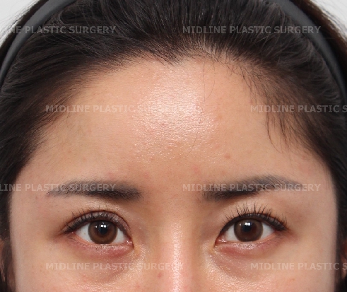 I want to remove my forehead implant because it makes my forehead look too voluminous, and I also want a forehead lift at the same time. (Feat. under-eye fat repositioning + fat grafting) image 2