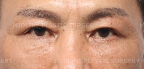 나이 들어 보이는 눈밑! 하안검으로 개선 가능한 부분들을 성형외과 전문의가 직접 알려드립니다. 관련 이미지 7