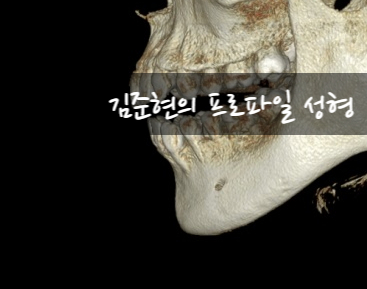노마스크 시대를 대비한 턱끝전진술과 미드업2040으로 턱선만들기!! 관련 이미지 17