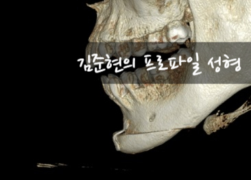노마스크 시대를 대비한 턱끝전진술과 미드업2040으로 턱선만들기!! 관련 이미지 18