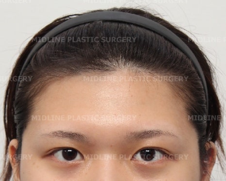 Forehead Lift for a Forehead with Prominent Brow Bones?? image 10