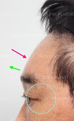 Endoscopic forehead lift that removes wrinkles and creates natural forehead volume! image 8