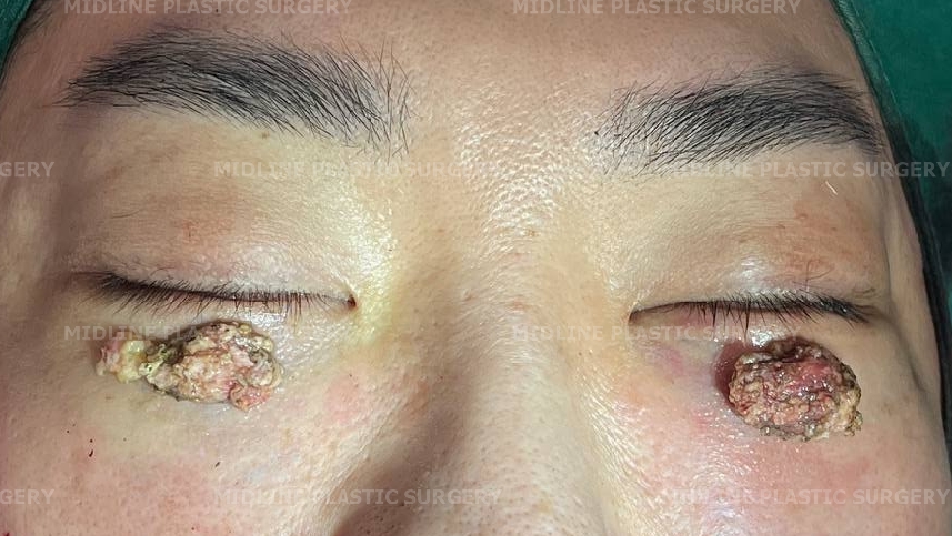 I Want to Get Rid of the Foreign Material Under My Eyes (Radiesse)ㅠ A Plastic Surgeon Explains Cases of Under-Eye Foreign Material Removal image 2