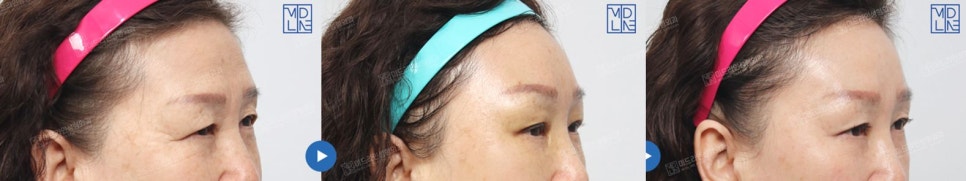 Endoscopic forehead lift that removes wrinkles and creates natural forehead volume! image 15