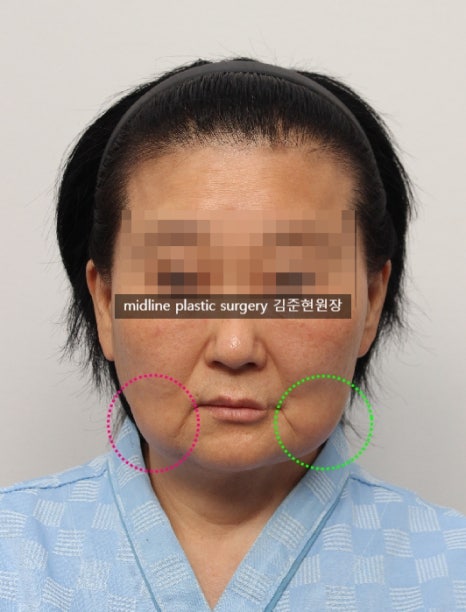 안면거상 흉터를 보여주는 곳은 없어서 미드라인성형외과가 보여드립니다. (feat. 심부볼리프팅) 관련 이미지 5