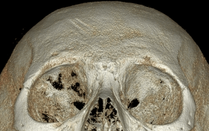 Let’s Learn About the Effects of Brow Bone Reduction Surgery. (Brow Bone? Eye Hole Bone? Here’s a Terminology Guide.) image 25