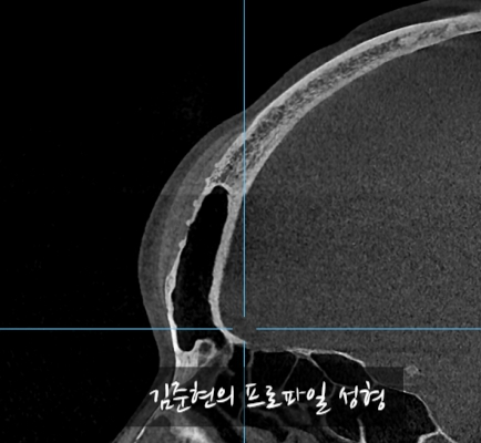 I Removed Two Forehead Implants. A Board-Certified Plastic Surgeon Explains Why I Do Not Recommend Forehead Implants. image 5