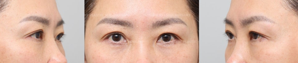 I don’t like bulging under-eye fat, dark circles, or wrinkles under the eyes. I’ll explain the no-touch lower blepharoplasty and fat grafting procedure. image 7