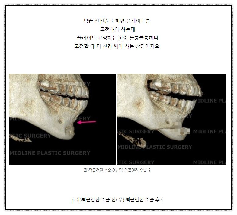 윤곽 후 핀제거 수술 케이스, 꼭 필요한 것인가? 관련 이미지 2