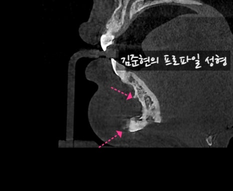 앞턱 보형물이 턱 옆으로 뚫고 나와요ㅠㅠ앞턱 보형물 제거 후 턱끝전진술을 한 케이스를 성형외과 전문의가 설명합니다. 관련 이미지 18