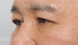 나이 들어 보이는 눈밑! 하안검으로 개선 가능한 부분들을 성형외과 전문의가 직접 알려드립니다. 관련 이미지 15