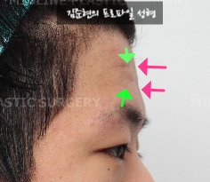 How Can Deep Forehead Wrinkles Be Resolved? (Feat. Forehead Lift + Filler) image 10
