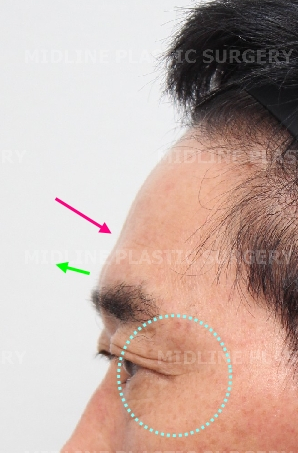 Endoscopic forehead lift that removes wrinkles and creates natural forehead volume! image 9