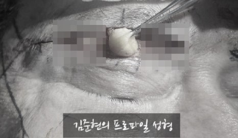 처지고 통통한(Puffy) 눈꺼풀 탈출하기!눈썹하거상(Subbrow lift)과 눈 위 지방제거(Feat. 하안검, 지방이식) 관련 이미지 5