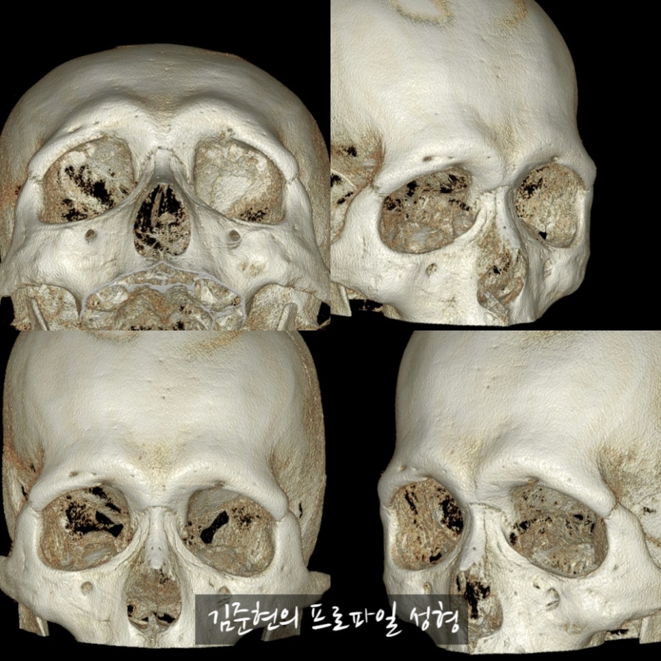 눈썹뼈절삭, 어떨 때 어떻게 하는 수술일까요? 꼭 이마거상과 함께 해야만 하는 수술인가요? 미드라인성형외과에서 하는 눈썹뼈절삭 수술을 설명드립니다. (3D CT 있음) 관련 이미지 4