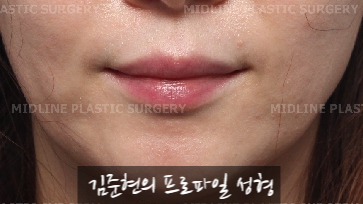입술에 볼륨을 주는 방법은? 입술 지방이식에 관하여 관련 이미지 7