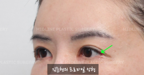 The outer corners of my eyes are open and my eyes stingㅠㅠI had lateral canthoplasty revision and eye corner restoration.(feat. Endoscopic forehead lift) image 3