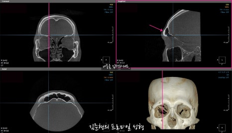 눈썹뼈절삭, 어떨 때 어떻게 하는 수술일까요? 꼭 이마거상과 함께 해야만 하는 수술인가요? 미드라인성형외과에서 하는 눈썹뼈절삭 수술을 설명드립니다. (3D CT 있음) 관련 이미지 8