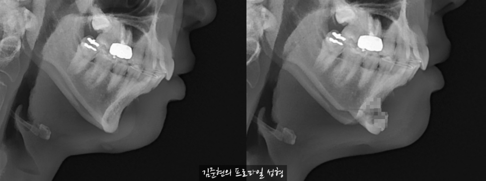 앞턱 보형물이 턱 아래로 뚫고 나와요..ㅠㅠ 앞턱 보형물 제거 후 턱끝 전진술한 경우를 성형외과 전문의가 설명드립니다. 관련 이미지 6