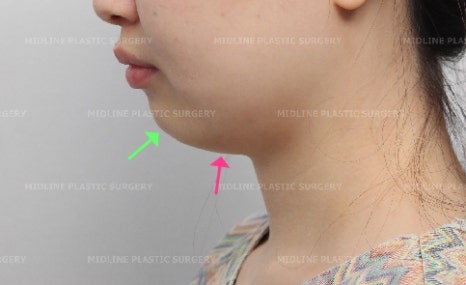 노마스크 시대를 대비한 턱끝전진술과 미드업2040으로 턱선만들기!! 관련 이미지 15