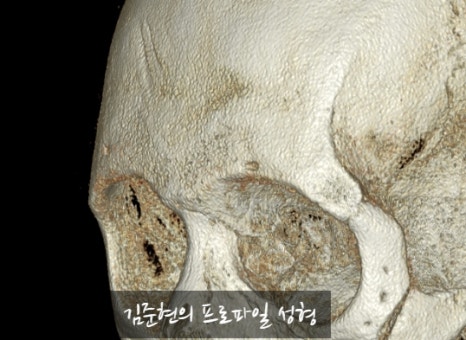 Let’s Learn About the Effects of Brow Bone Reduction Surgery. (Brow Bone? Eye Hole Bone? Here’s a Terminology Guide.) image 28