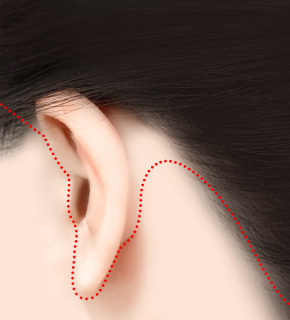 Fixing Sagging After Facial Contouring Surgery with a Face Lift!! (Feat. Plate Removal, Plate & Screw Removal) image 7