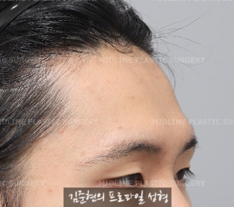 눈썹뼈절삭, 어떨 때 어떻게 하는 수술일까요? 꼭 이마거상과 함께 해야만 하는 수술인가요? 미드라인성형외과에서 하는 눈썹뼈절삭 수술을 설명드립니다. (3D CT 있음) 관련 이미지 2