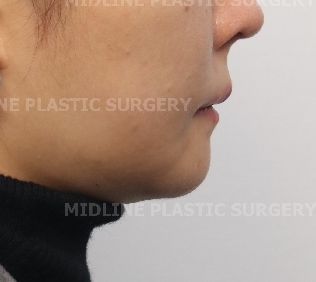 A Specialist Explains Chin Advancement Surgery After Removal of a Receded Chin Implant image 9
